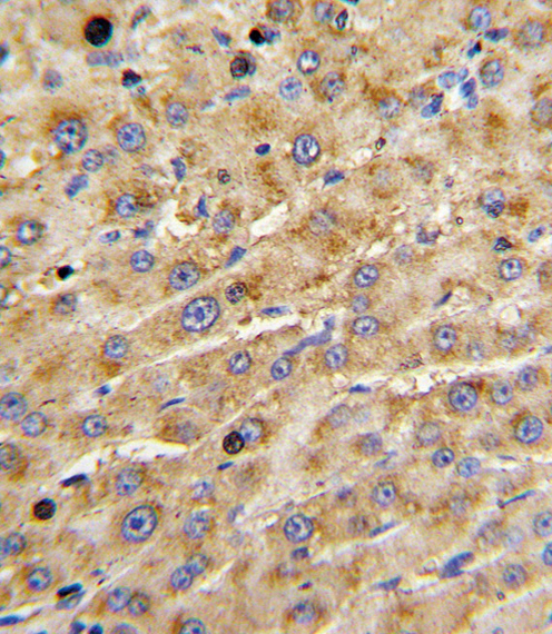ADAMTS13 Antibody - Formalin-fixed and paraffin-embedded human hepatocarcinoma with ADAMTS13 Antibody , which was peroxidase-conjugated to the secondary antibody, followed by DAB staining. This data demonstrates the use of this antibody for immunohistochemistry; clinical relevance has not been evaluated.