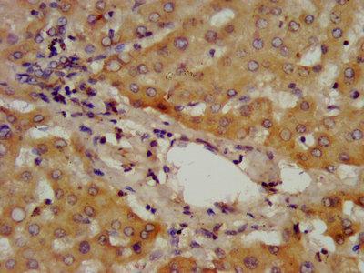 ADAMTS13 Antibody - Immunohistochemistry image at a dilution of 1:400 and staining in paraffin-embedded human liver tissue performed on a Leica BondTM system. After dewaxing and hydration, antigen retrieval was mediated by high pressure in a citrate buffer (pH 6.0) . Section was blocked with 10% normal goat serum 30min at RT. Then primary antibody (1% BSA) was incubated at 4 °C overnight. The primary is detected by a biotinylated secondary antibody and visualized using an HRP conjugated SP system.