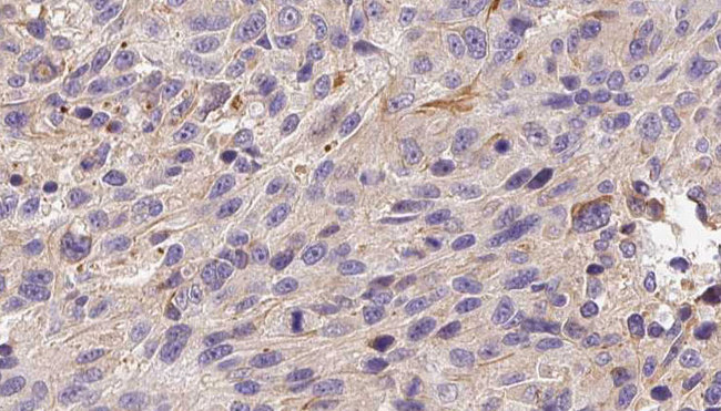 ADAMTS13 Antibody - 1:100 staining human Melanoma tissue by IHC-P. The sample was formaldehyde fixed and a heat mediated antigen retrieval step in citrate buffer was performed. The sample was then blocked and incubated with the antibody for 1.5 hours at 22°C. An HRP conjugated goat anti-rabbit antibody was used as the secondary.