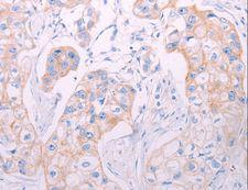 ADAMTS14 Antibody - Immunohistochemistry of paraffin-embedded Human breast cancer using ADAMTS14 Polyclonal Antibody at dilution of 1:50.