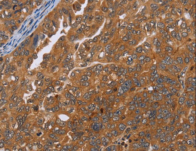 ADAMTS15 Antibody - Immunohistochemistry of paraffin-embedded Human thyroid cancer using ADAMTS15 Polyclonal Antibody at dilution of 1:40.