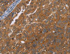 ADAMTS15 Antibody - Immunohistochemistry of paraffin-embedded Human thyroid cancer using ADAMTS15 Polyclonal Antibody at dilution of 1:40.