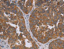 ADAMTS15 Antibody - Immunohistochemistry of paraffin-embedded Human cervical cancer using ADAMTS15 Polyclonal Antibody at dilution of 1:60.
