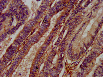 ADAMTS15 Antibody - Immunohistochemistry image at a dilution of 1:400 and staining in paraffin-embedded human colon cancer performed on a Leica BondTM system. After dewaxing and hydration, antigen retrieval was mediated by high pressure in a citrate buffer (pH 6.0) . Section was blocked with 10% normal goat serum 30min at RT. Then primary antibody (1% BSA) was incubated at 4 °C overnight. The primary is detected by a biotinylated secondary antibody and visualized using an HRP conjugated SP system.