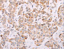 ADAMTS16 Antibody - Immunohistochemistry of paraffin-embedded Human colon cancer using ADAMTS16 Polyclonal Antibody at dilution of 1:50.