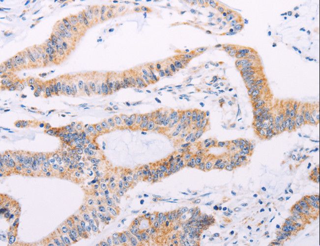 ADAMTS16 Antibody - Immunohistochemistry of paraffin-embedded Human colon cancer using ADAMTS16 Polyclonal Antibody at dilution of 1:50.