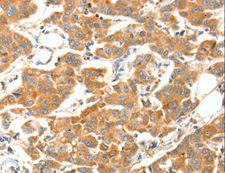 ADAMTS18 Antibody - Immunohistochemistry of paraffin-embedded Human cervical cancer using ADAMTS18 Polyclonal Antibody at dilution of 1:30.