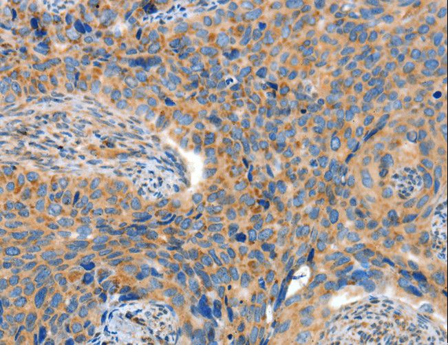 ADAMTS18 Antibody - Immunohistochemistry of paraffin-embedded Human cervical cancer using ADAMTS18 Polyclonal Antibody at dilution of 1:30.