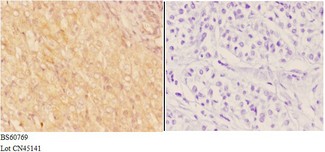ADAMTS18 Antibody - Immunohistochemistry (IHC) analysis of ADAMTS18 antibody in paraffin-embedded human liver carcinoma tissue at 1:50, showing cytoplasm staining. Negative control (the right) using PBS instead of primary antibody. Secondary antibody is Goat Anti-Rabbit IgG-biotin f.