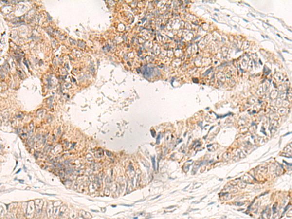 ADAMTS2 Antibody - Immunohistochemistry of paraffin-embedded Human colorectal cancer tissue  using ADAMTS2 Polyclonal Antibody at dilution of 1:40(×200)