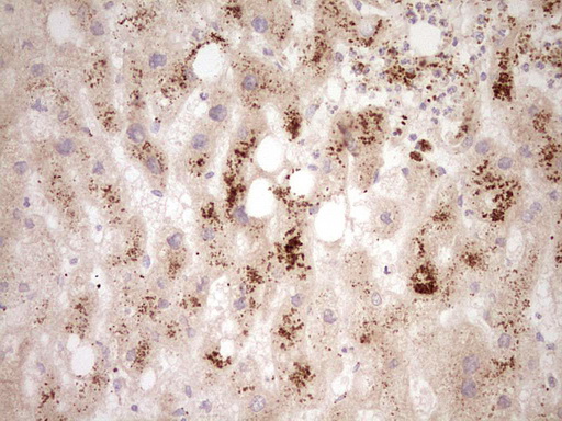 ADAMTS4 Antibody - Immunohistochemical staining of paraffin-embedded Human liver tissue within the normal limits using anti-ADAMTS4 mouse monoclonal antibody. (Heat-induced epitope retrieval by Tris-EDTA, pH8.0) Dilution: 1:150
