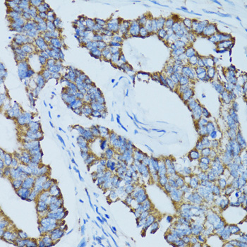 ADAMTS4 Antibody - Immunohistochemistry of paraffin-embedded human colon carcinoma tissue.
