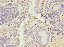 ADAMTS4 Antibody - Immunohistochemistry of paraffin-embedded human gastric cancer using antibody at 1:100 dilution.  This image was taken for the unconjugated form of this product. Other forms have not been tested.