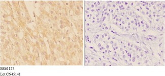 ADAMTS7 Antibody - Immunohistochemistry (IHC) analysis of ADAMTS7 antibody in paraffin-embedded human liver carcinoma tissue at 1:50, showing cytoplasm and secreted staining. Negative control (the right) using PBS instead of primary antibody. Secondary antibody is Goat Anti-Rabbit.