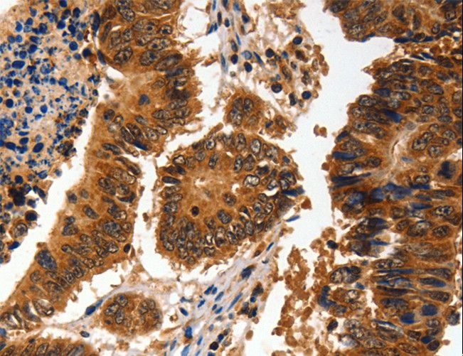ADAP1 / CENTA1 Antibody - Immunohistochemistry of paraffin-embedded Human colon cancer using ADAP1 Polyclonal Antibody at dilution of 1:60.