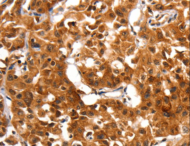 ADAP1 / CENTA1 Antibody - Immunohistochemistry of paraffin-embedded Human lung cancer using ADAP1 Polyclonal Antibody at dilution of 1:60.