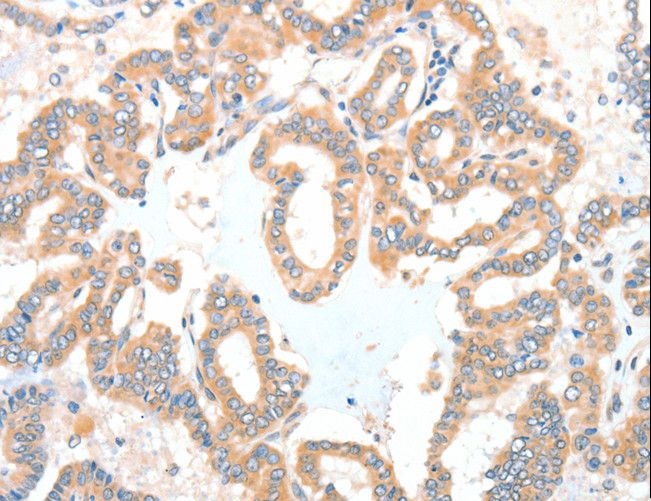 ADCK1 Antibody - Immunohistochemistry of paraffin-embedded Human thyroid cancer using ADCK1 Polyclonal Antibody at dilution of 1:40.