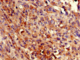 ADCK4 Antibody - Immunohistochemistry of paraffin-embedded human melanoma cancer using ADCK4 Antibody at dilution of 1:100