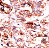 ADCK5 Antibody - Formalin-fixed and paraffin-embedded human cancer tissue reacted with the primary antibody, which was peroxidase-conjugated to the secondary antibody, followed by AEC staining. This data demonstrates the use of this antibody for immunohistochemistry; clinical relevance has not been evaluated. BC = breast carcinoma; HC = hepatocarcinoma.