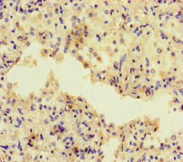 ADCY1 / Adenylate Cyclase 1 Antibody - Immunohistochemistry of paraffin-embedded human lung cancer at dilution of 1:100
