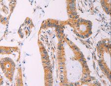 ADCY1 / Adenylate Cyclase 1 Antibody - Immunohistochemistry of paraffin-embedded Human liver cancer using ADCY1 Polyclonal Antibody at dilution of 1:60.