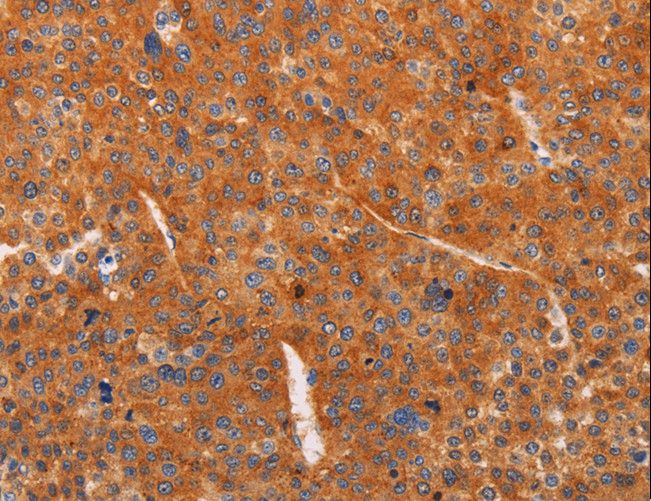 ADCY1 / Adenylate Cyclase 1 Antibody - Immunohistochemistry of paraffin-embedded Human liver cancer using ADCY1 Polyclonal Antibody at dilution of 1:60.