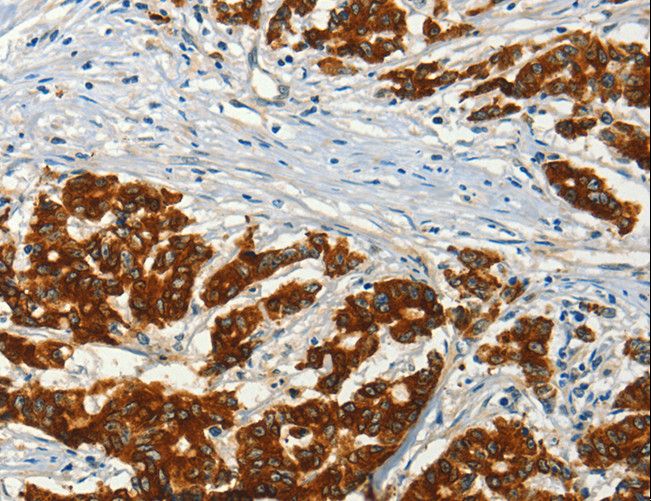 ADCY3 / Adenylate Cyclase 3 Antibody - Immunohistochemistry of paraffin-embedded Human colon cancer using ADCY3 Polyclonal Antibody at dilution of 1:50.