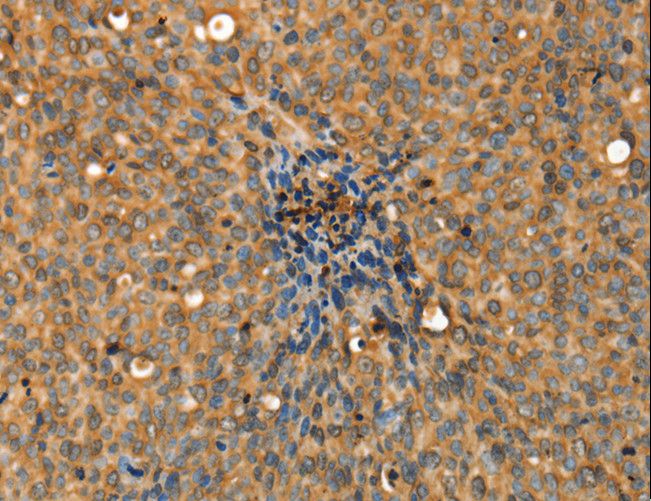 ADCY3 / Adenylate Cyclase 3 Antibody - Immunohistochemistry of paraffin-embedded Human thyroid cancer using ADCY3 Polyclonal Antibody at dilution of 1:30.