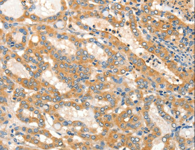 ADCY3 / Adenylate Cyclase 3 Antibody - Immunohistochemistry of paraffin-embedded Human thyroid cancer using ADCY3 Polyclonal Antibody at dilution of 1:30.