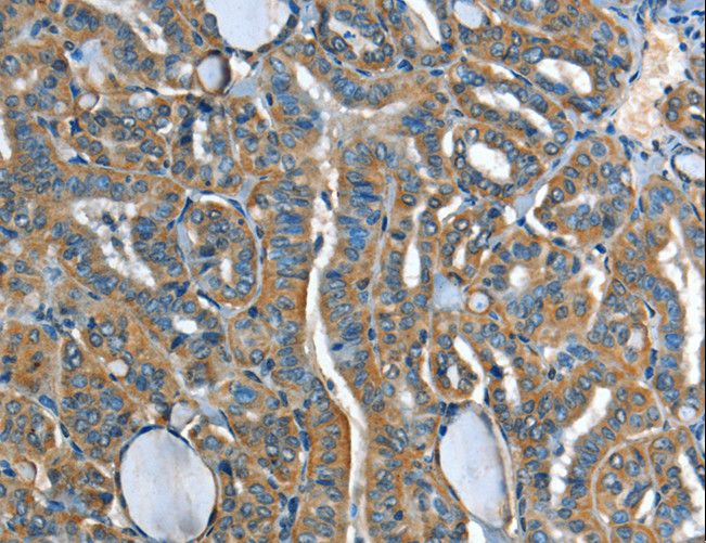 ADCY4 / Adenylate Cyclase 4 Antibody - Immunohistochemistry of paraffin-embedded Human liver cancer using ADCY4 Polyclonal Antibody at dilution of 1:45.