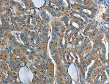 ADCY4 / Adenylate Cyclase 4 Antibody - Immunohistochemistry of paraffin-embedded Human liver cancer using ADCY4 Polyclonal Antibody at dilution of 1:45.