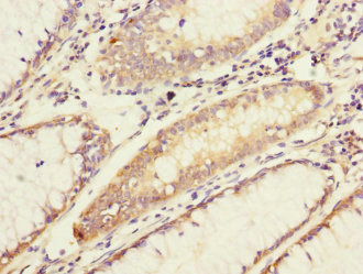 ADCY4 / Adenylate Cyclase 4 Antibody - Immunohistochemistry of paraffin-embedded human colon cancer at dilution 1:100