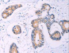 ADCY5 / Adenylate Cyclase 5 Antibody - Immunohistochemistry of paraffin-embedded Human thyroid cancer using ADCY5 Polyclonal Antibody at dilution of 1:30.