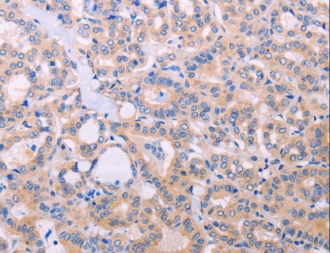 ADCY5 / Adenylate Cyclase 5 Antibody - Immunohistochemistry of paraffin-embedded Human thyroid cancer using ADCY5 Polyclonal Antibody at dilution of 1:30.