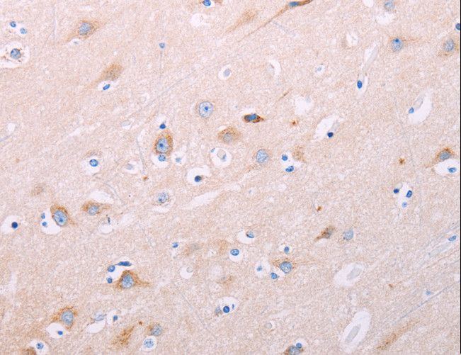 ADCY5 / Adenylate Cyclase 5 Antibody - Immunohistochemistry of paraffin-embedded Human thyroid cancer using ADCY5 Polyclonal Antibody at dilution of 1:40.