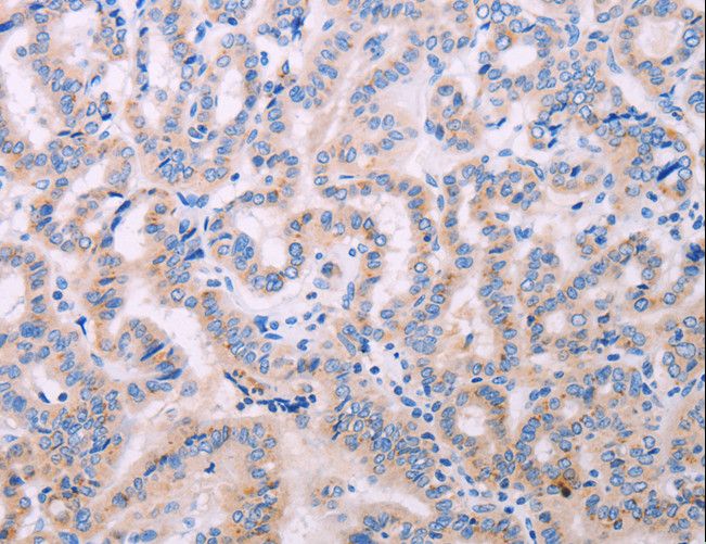 ADCY5 / Adenylate Cyclase 5 Antibody - Immunohistochemistry of paraffin-embedded Human thyroid cancer using ADCY5 Polyclonal Antibody at dilution of 1:40.