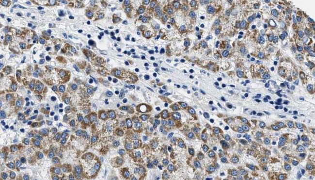 ADCY5 / Adenylate Cyclase 5 Antibody - 1:100 staining human liver carcinoma tissues by IHC-P. The sample was formaldehyde fixed and a heat mediated antigen retrieval step in citrate buffer was performed. The sample was then blocked and incubated with the antibody for 1.5 hours at 22°C. An HRP conjugated goat anti-rabbit antibody was used as the secondary.