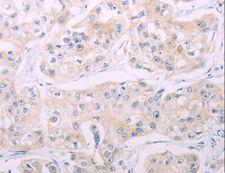 ADCY7 / Adenylate Cyclase 7 Antibody - Immunohistochemistry of paraffin-embedded Human breast cancer using ADCY7 Polyclonal Antibody at dilution of 1:60.