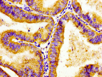 ADCY8 / Adenylate Cyclase 8 Antibody - Immunohistochemistry image of paraffin-embedded human endometrial cancer at a dilution of 1:100