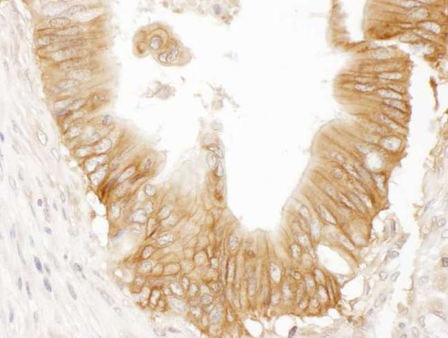 ADCY9 / Adenylate Cyclase 9 Antibody - Detection of human AC9 by immunohistochemistry. Sample: FFPE section of human prostate carcinoma. Antibody: Affinity purified rabbit anti- AC9 used at a dilution of 1:1,000 (1µg/ml). Detection: DAB