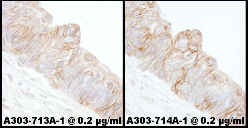ADD1 / Adducin Alpha Antibody - Detection of Human Alpha-Adducin by Immunohistochemistry. Samples: FFPE sections of human ovarian carcinoma. Antibody: Affinity purified rabbit anti-Alpha-Adducin1:5000 (0.2 ug/ml) (left). Detection: DAB.