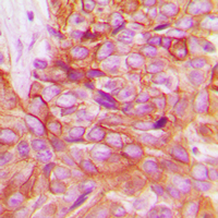 ADD1 / Adducin Alpha Antibody - Immunohistochemical analysis of Alpha-adducin staining in human breast cancer formalin fixed paraffin embedded tissue section. The section was pre-treated using heat mediated antigen retrieval with sodium citrate buffer (pH 6.0). The section was then incubated with the antibody at room temperature and detected using an HRP-conjugated compact polymer system. DAB was used as the chromogen. The section was then counterstained with hematoxylin and mounted with DPX.