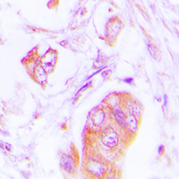 ADD1 / Adducin Alpha Antibody - Immunohistochemical analysis of Alpha-adducin staining in human lung cancer formalin fixed paraffin embedded tissue section. The section was pre-treated using heat mediated antigen retrieval with sodium citrate buffer (pH 6.0). The section was then incubated with the antibody at room temperature and detected using an HRP conjugated compact polymer system. DAB was used as the chromogen. The section was then counterstained with hematoxylin and mounted with DPX.