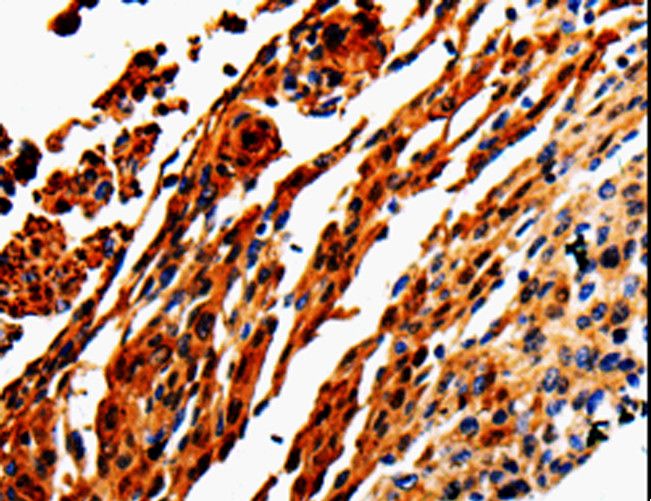 ADD1 / Adducin Alpha Antibody - Immunohistochemistry of paraffin-embedded Human lung cancer using ADD1 Polyclonal Antibody at dilution of 1:50.