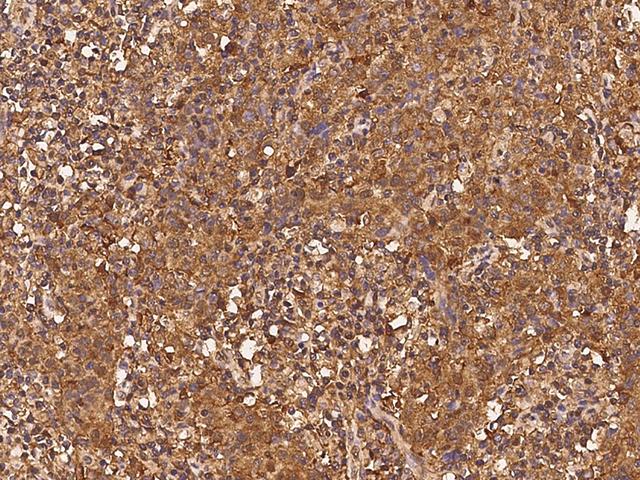 ADD1 / Adducin Alpha Antibody - Immunochemical staining of human ADD1 in human lung cancer with rabbit polyclonal antibody at 1:300 dilution, formalin-fixed paraffin embedded sections.