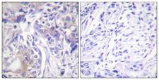 ADD1 / Adducin Alpha Antibody - Peptide - + Immunohistochemistry analysis of paraffin-embedded human breast carcinoma tissue using ADD1 antibody.