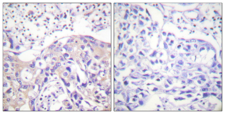 ADD1 / Adducin Alpha Antibody - Immunohistochemistry analysis of paraffin-embedded human breast carcinoma, using ADD1 (Phospho-Thr445) Antibody. The picture on the right is blocked with the phospho peptide.