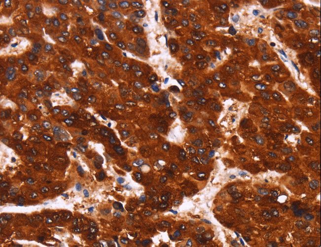 ADGRA2 / GPR124 Antibody - Immunohistochemistry of paraffin-embedded Human liver cancer using GPR124 Polyclonal Antibody at dilution of 1:40.