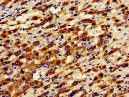ADGRA2 / GPR124 Antibody - Immunohistochemistry image of paraffin-embedded human liver cancer at a dilution of 1:100