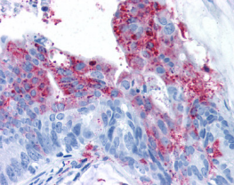ADGRA2 / GPR124 Antibody - Colon carcinoma: Formalin-fixed, paraffin-embedded.